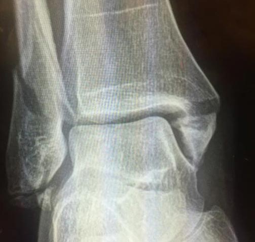 Troy Bayliss ankle injury Sacramento Mile 2015