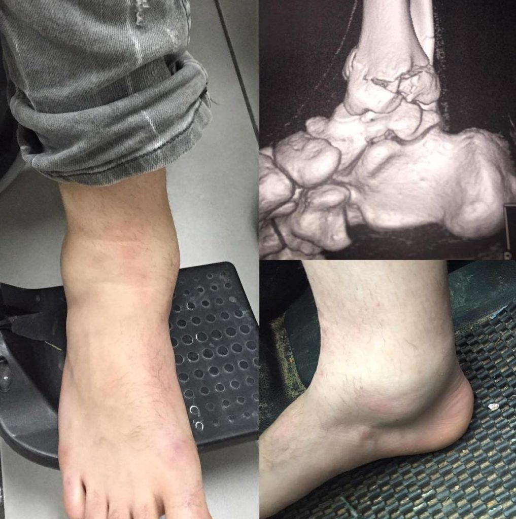 Jack Miller fractures tib-fib in MX accident