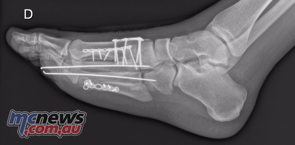 Loris Baz fractures - May 2016