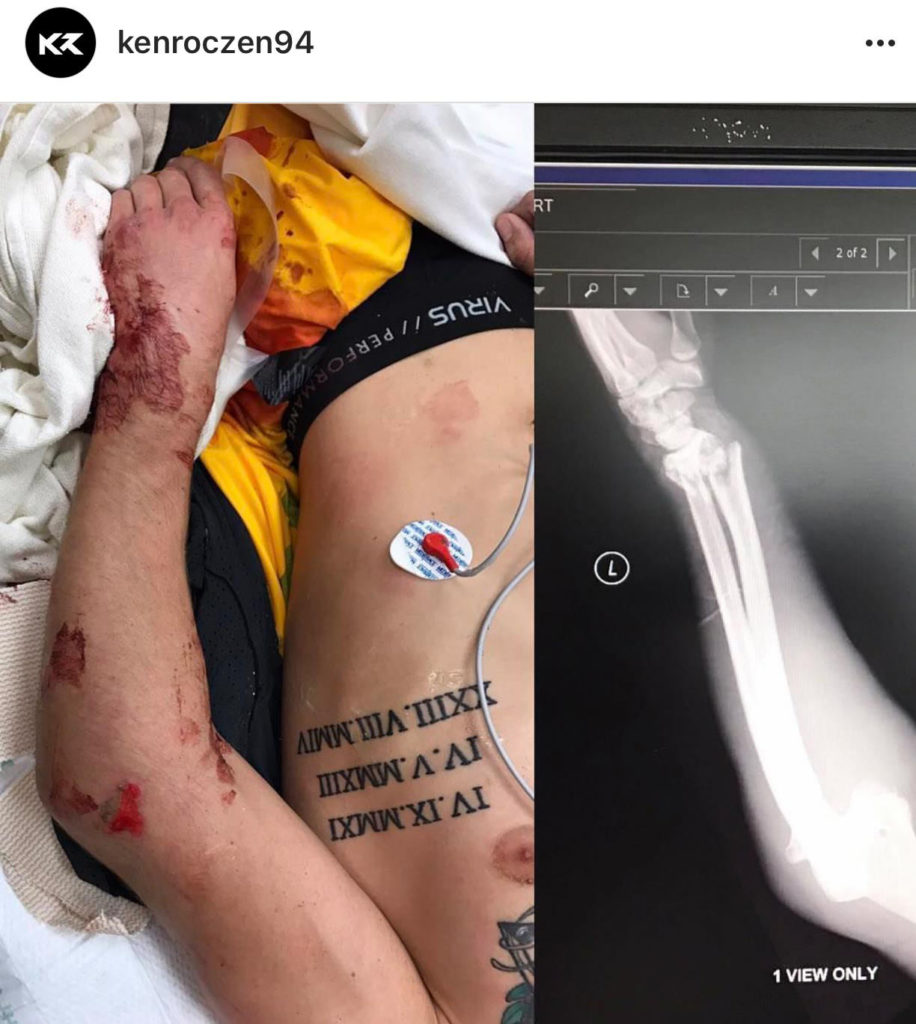 Ken Roczen suffers a compound fracture after a nasty fall in AMA Supercross