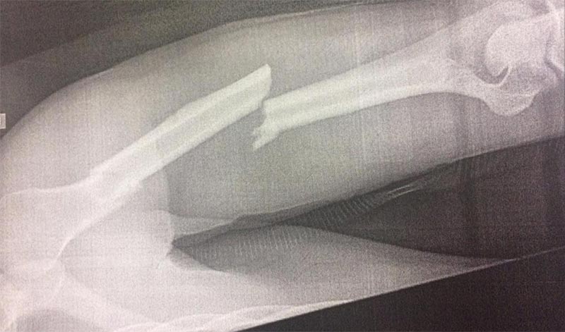 Glenn Allerton's broken arm. The injury was sustained during practice at Wakefield Park. March 17, 2017