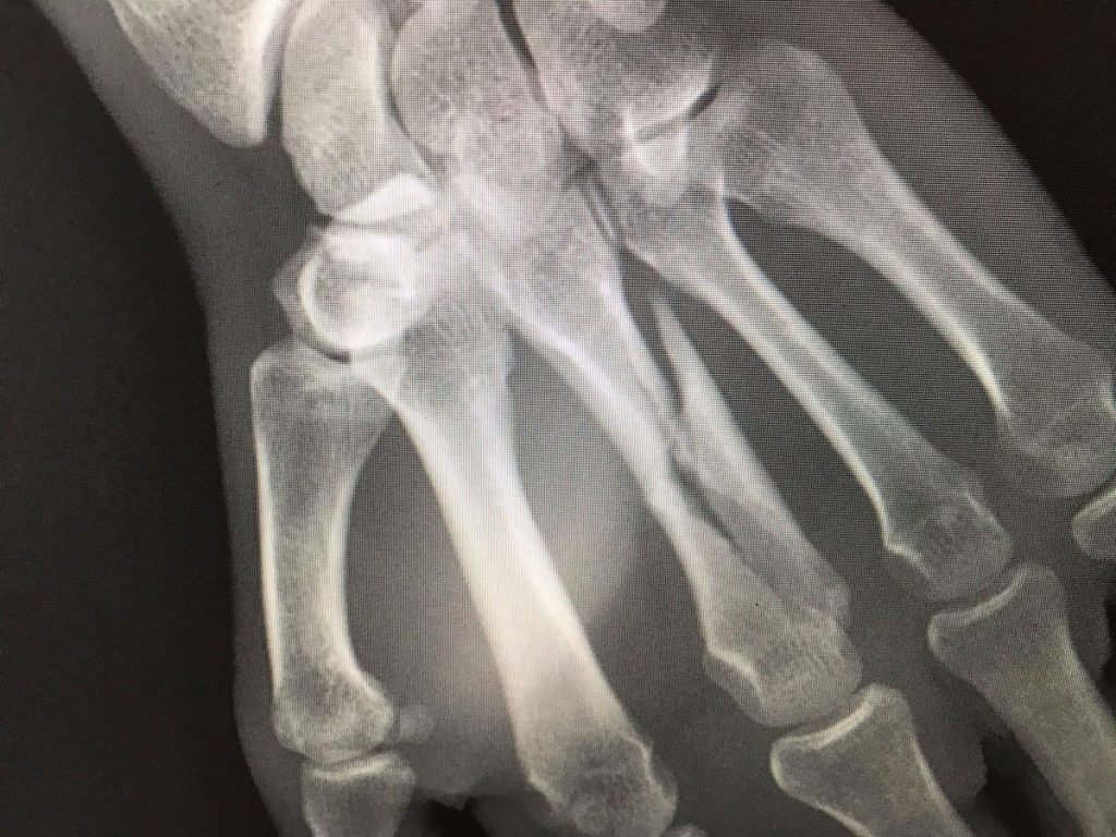 X-Ray of Shaun Simpsons hand