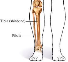 Generic Tib-Fib Diagram. Valentino Rossi has broken both his tibia and fibula. Rossi has suffered a displaced fracture, which means the bones are separated and not in their correct positions, and will most likely require plating. 