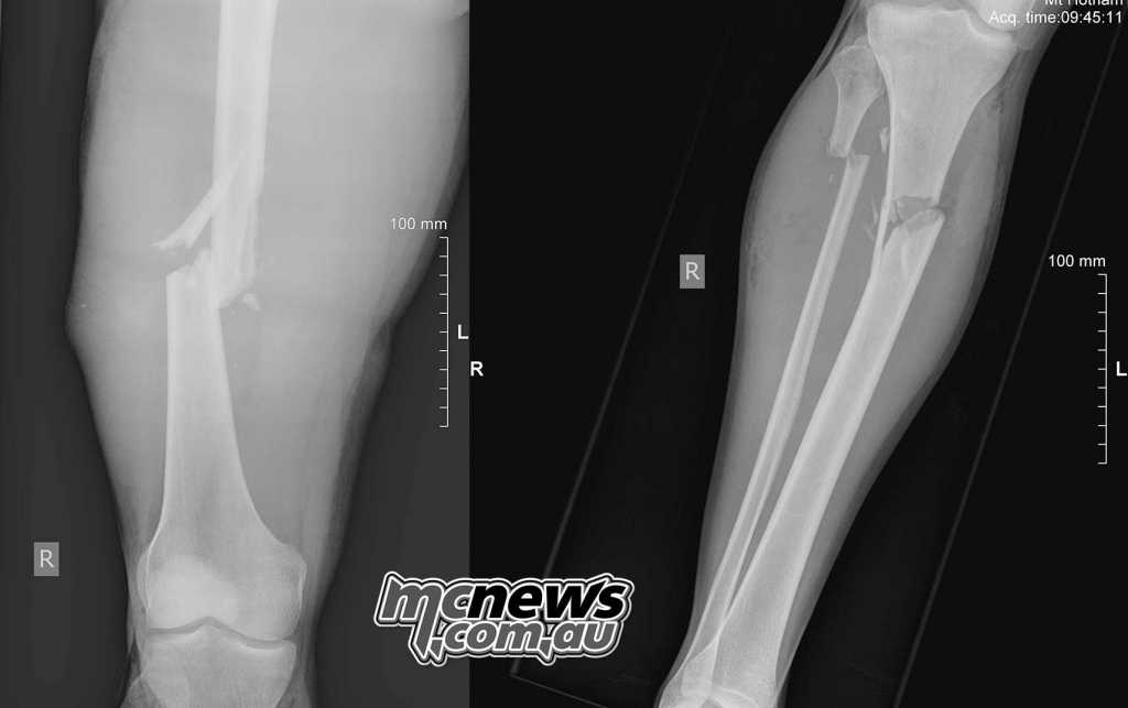 Some Brandon Demmery X-Rays following his Phillip Island crash in October 2017