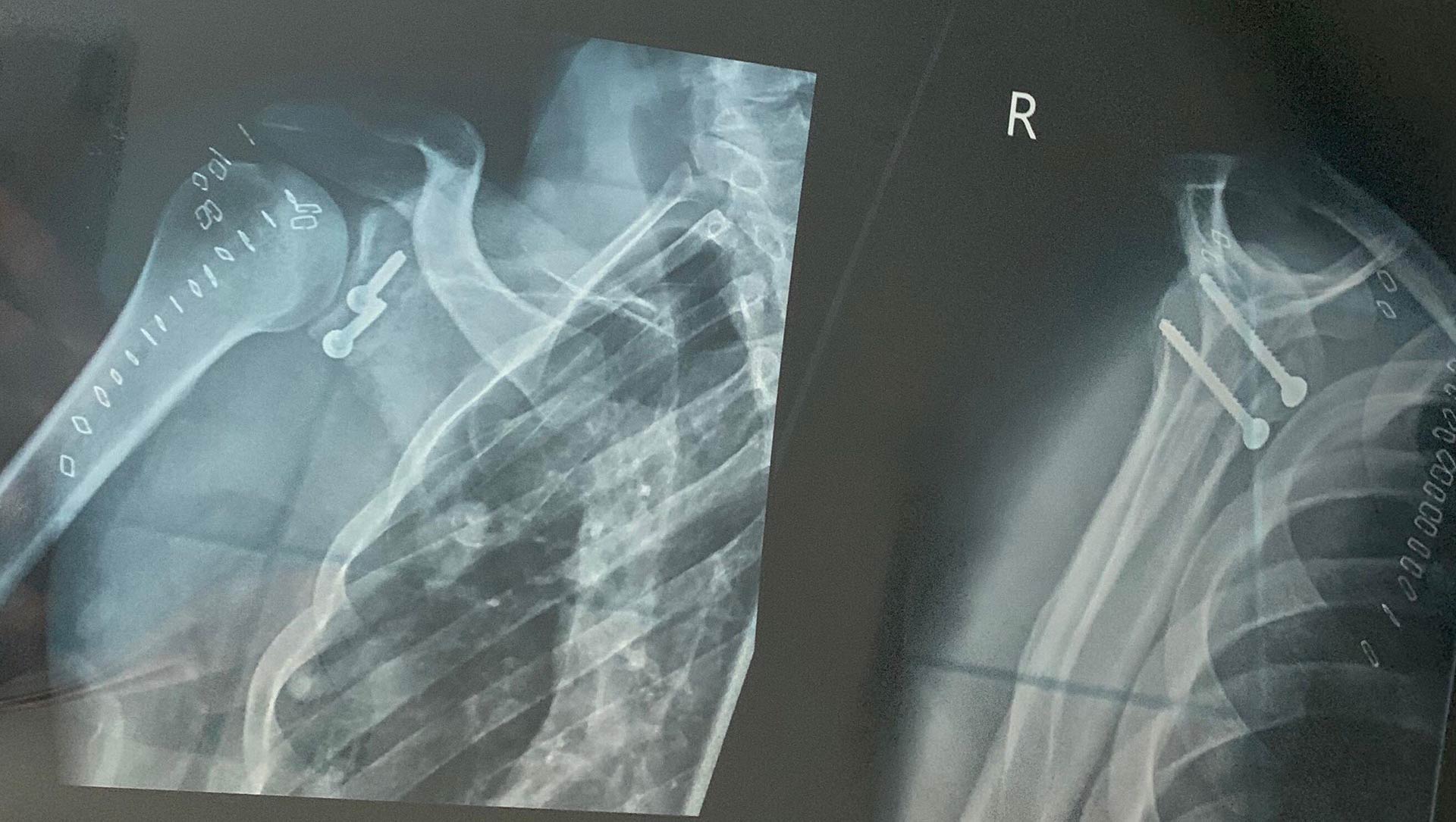 Aiden Wagner Shoulder XRay May